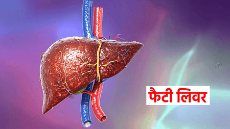 एसजीपीजीआई में जल्द शुरू होगा 'फैटी लिवर और मोटापा क्लिनिक', बढ़ते एनएएफएलडी मामलों पर फोकस